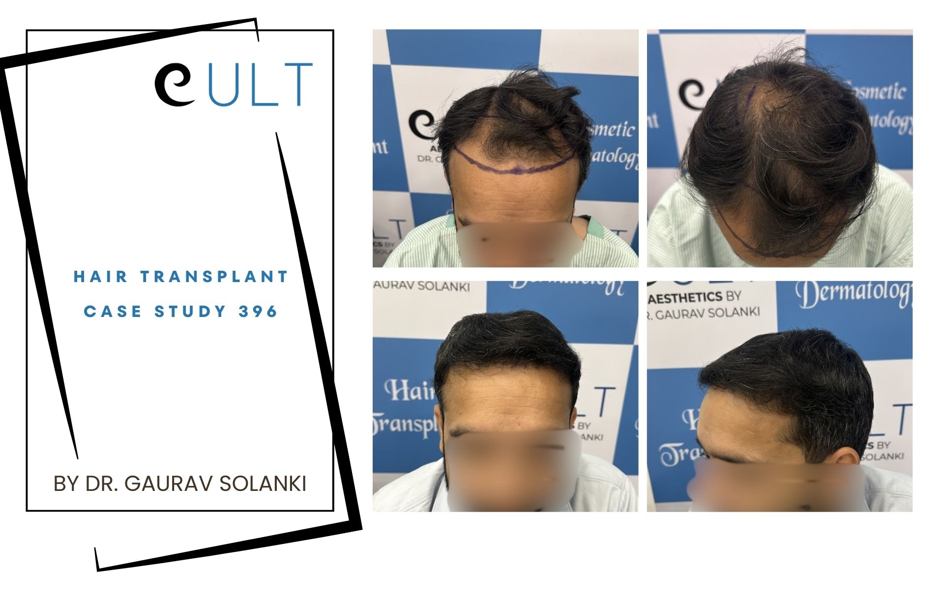 Hair Transplant case 396