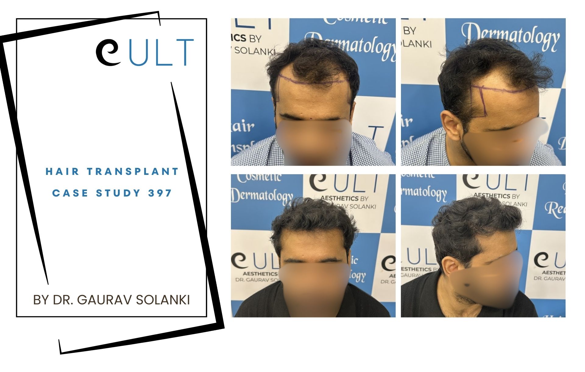 Hair Transplant case 397