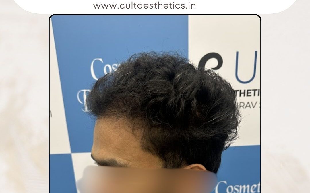 Hair Case 390 After 3