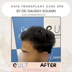 hair case 390 After-3