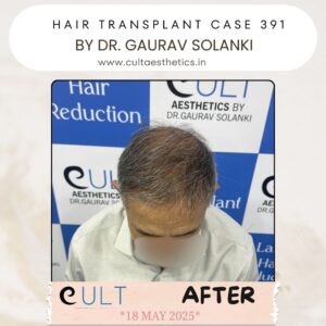 hair case 391 After-2