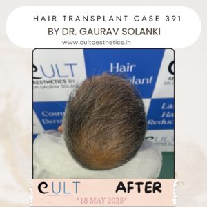 hair case 391 After-3