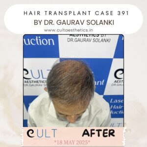 hair case 391 After-4