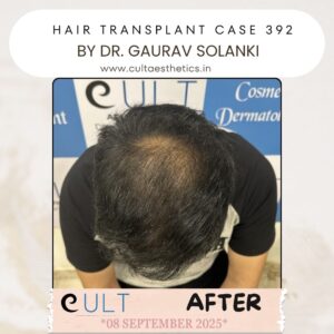 hair case 392 After-3