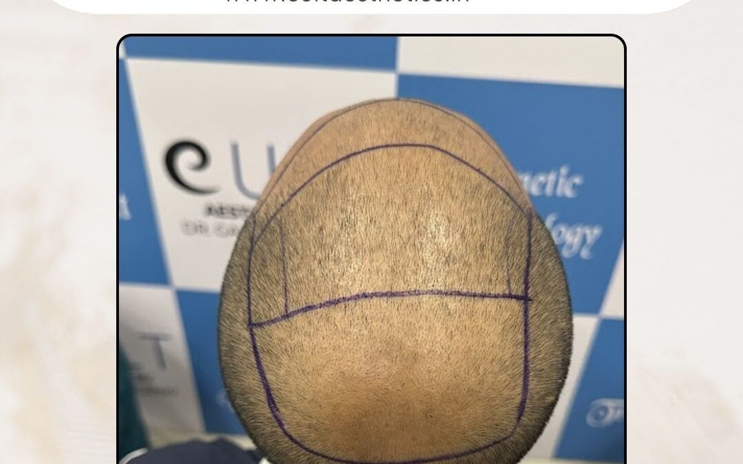 Hair Case 392 Before 3