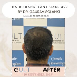 hair case 393 After-4