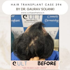 Hair Transplant Case 394 - Before Treatment at Cult Aesthetics Gurgaon