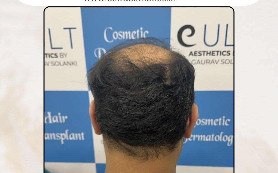 Hair Case 395 Before 4