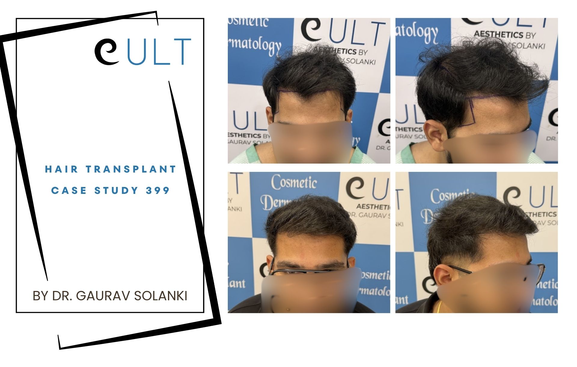 Hair Transplant case 399