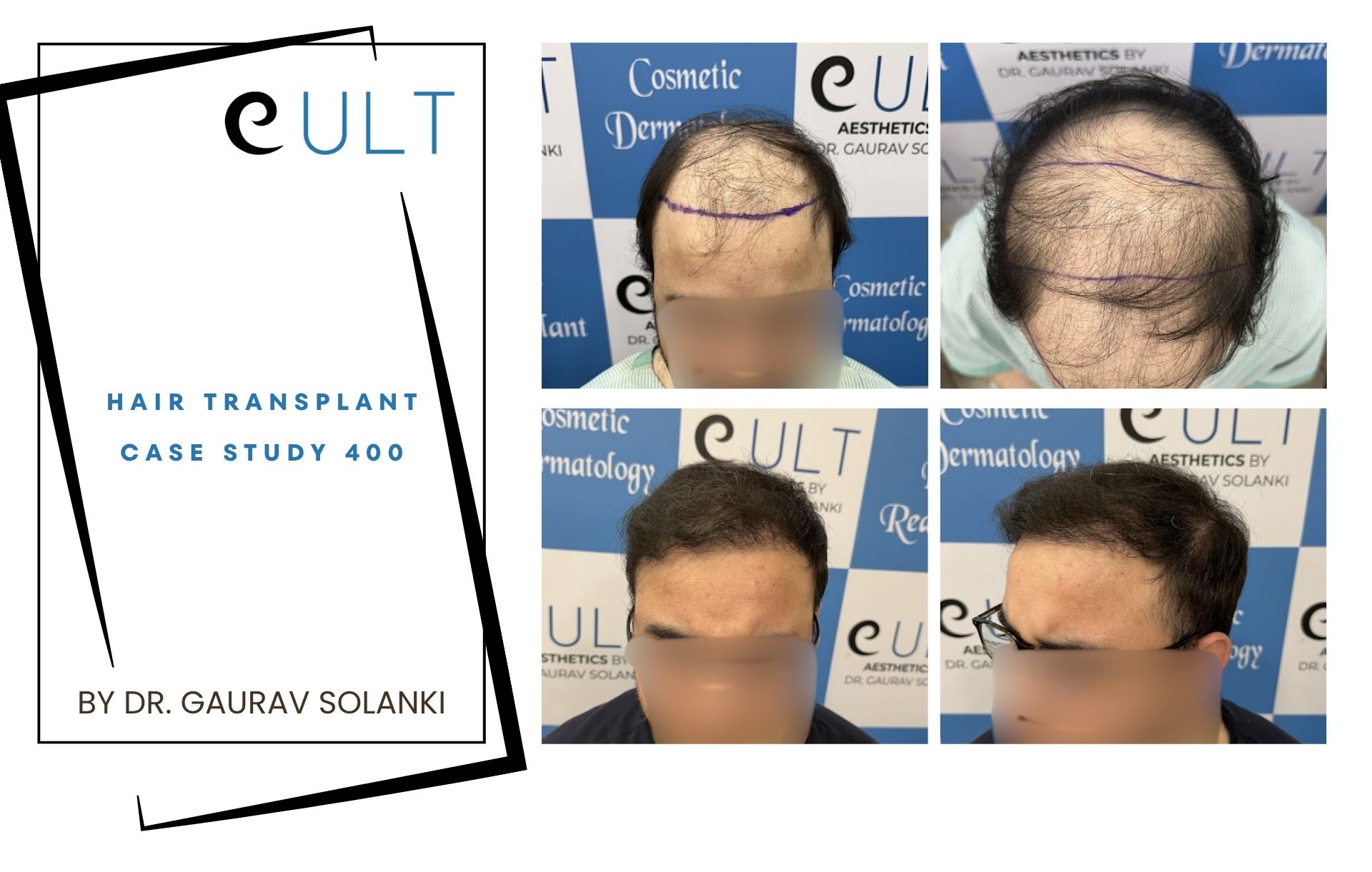 Hair Transplant case 400