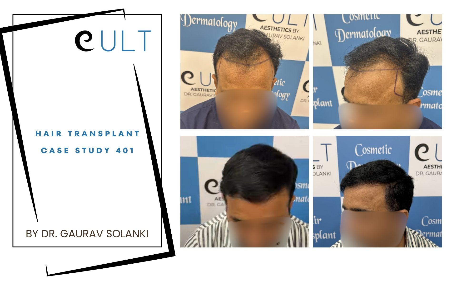 Hair Transplant case 401
