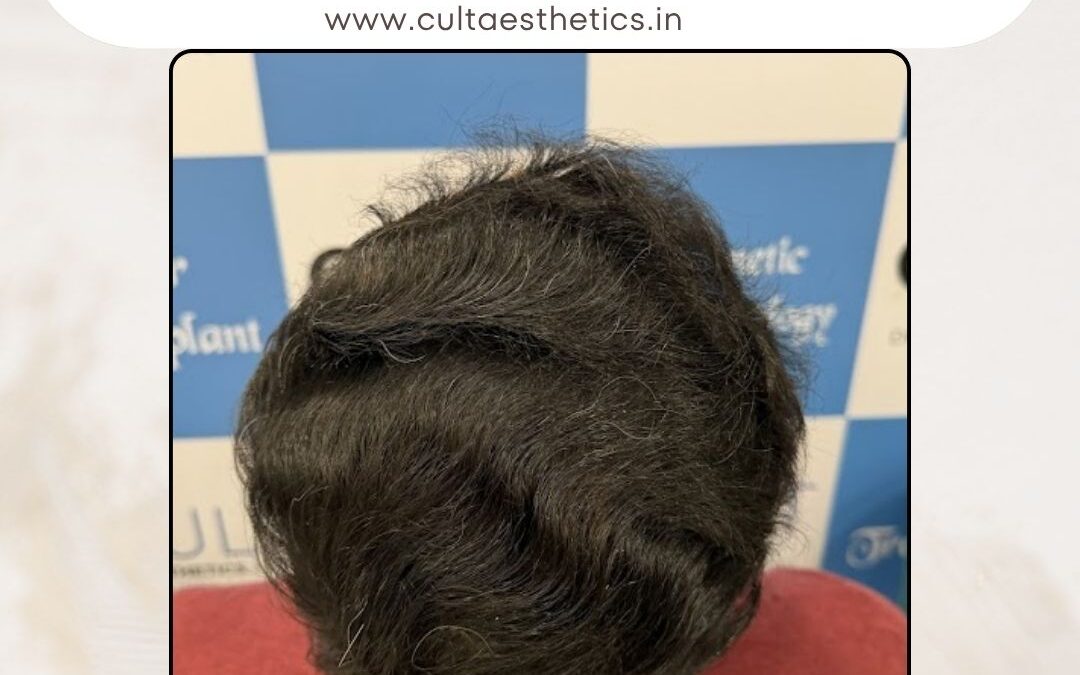 Hair Case 398 After 4
