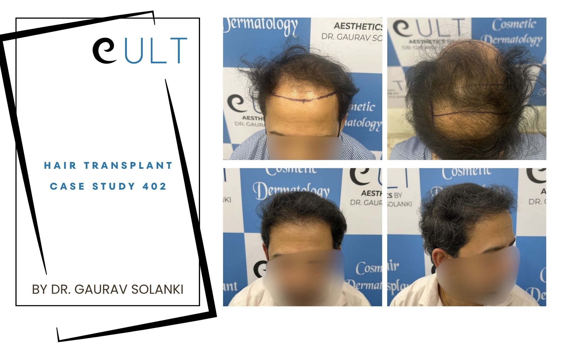 Hair Transplant case 402
