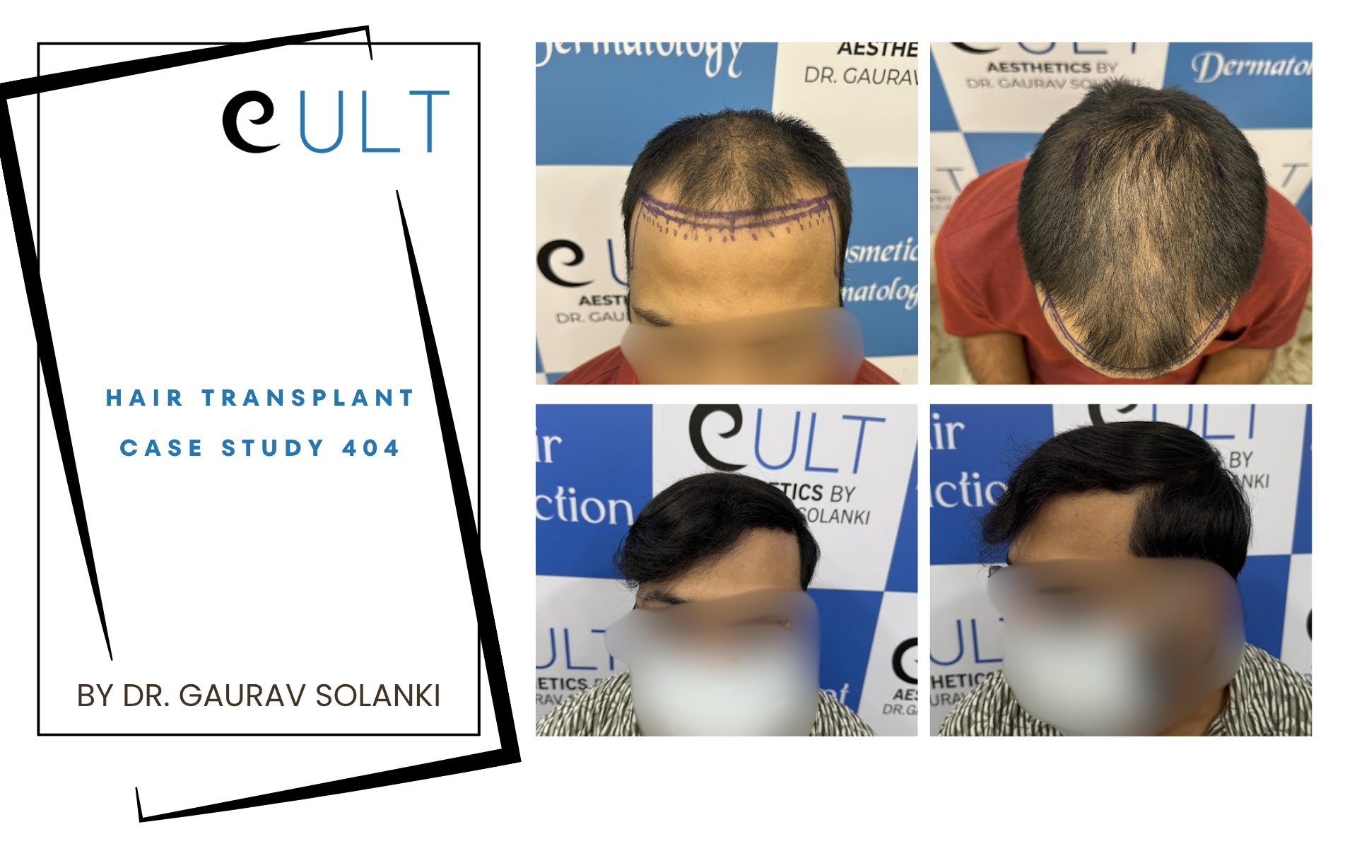 Hair Transplant case 404