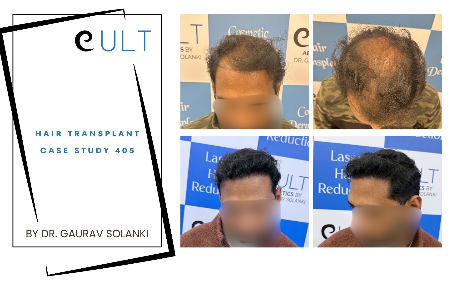 Hair Transplant case 405