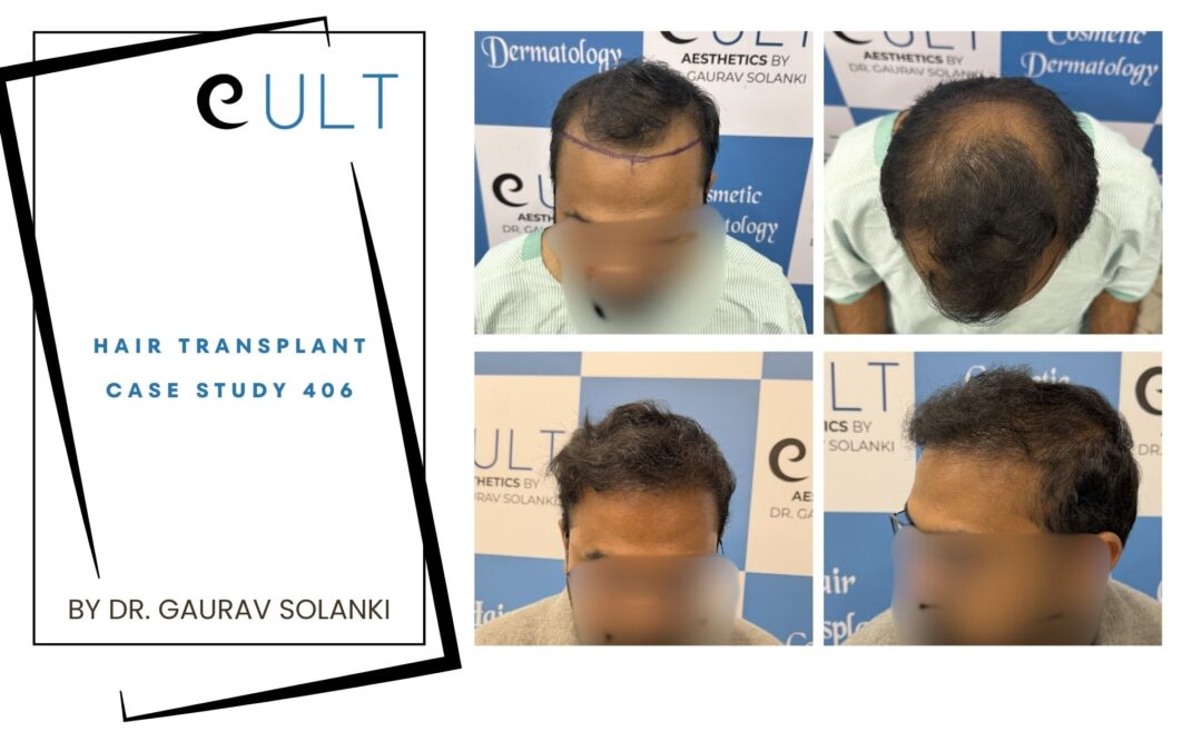 Hair Transplant Case 406