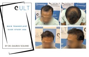 Hair Transplant case 406