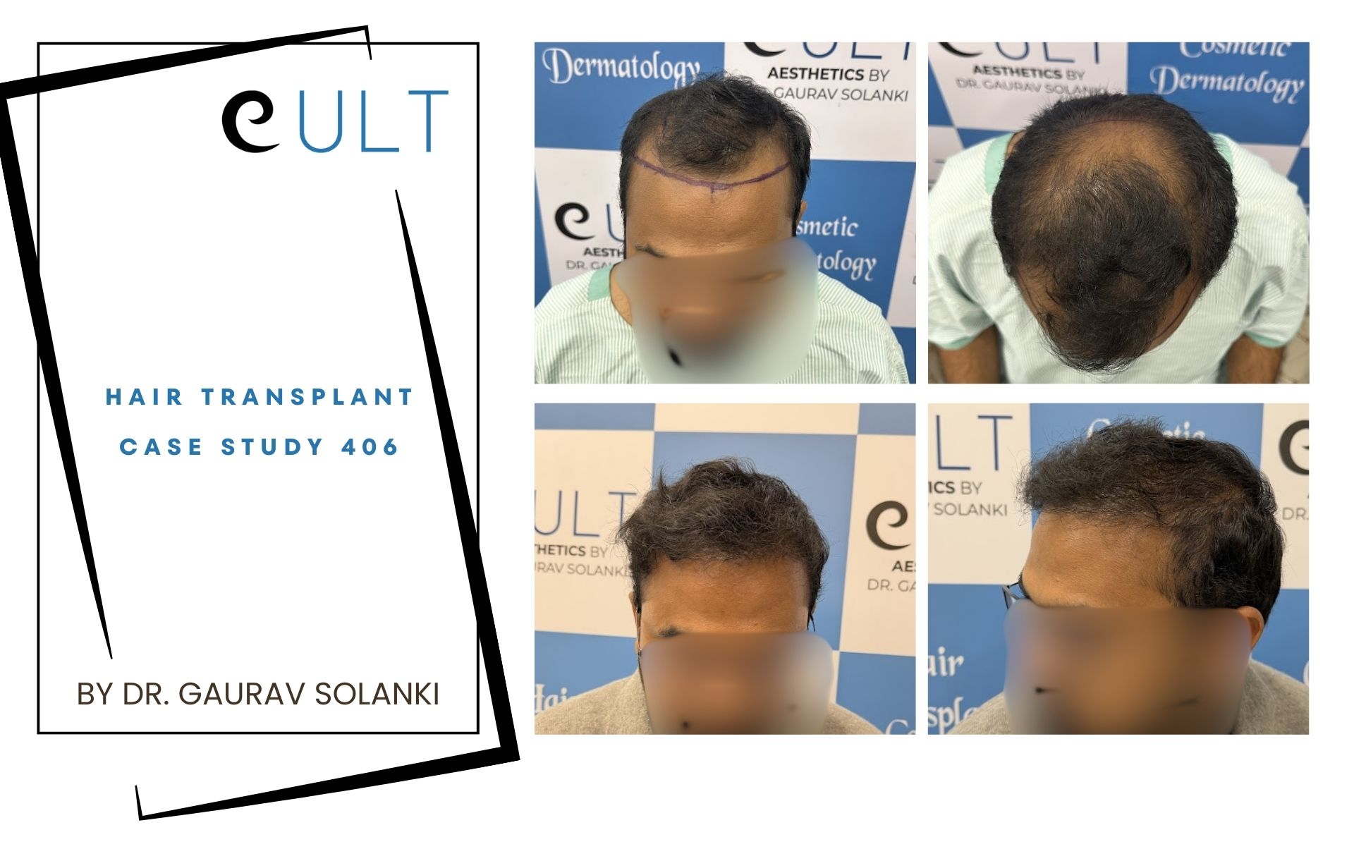 Hair Transplant case 406