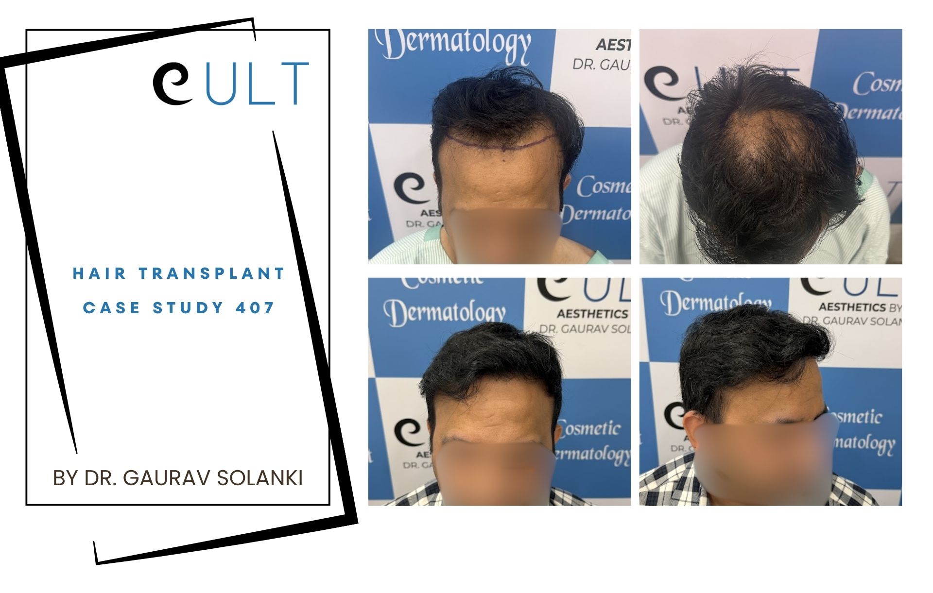 Hair Transplant case 407