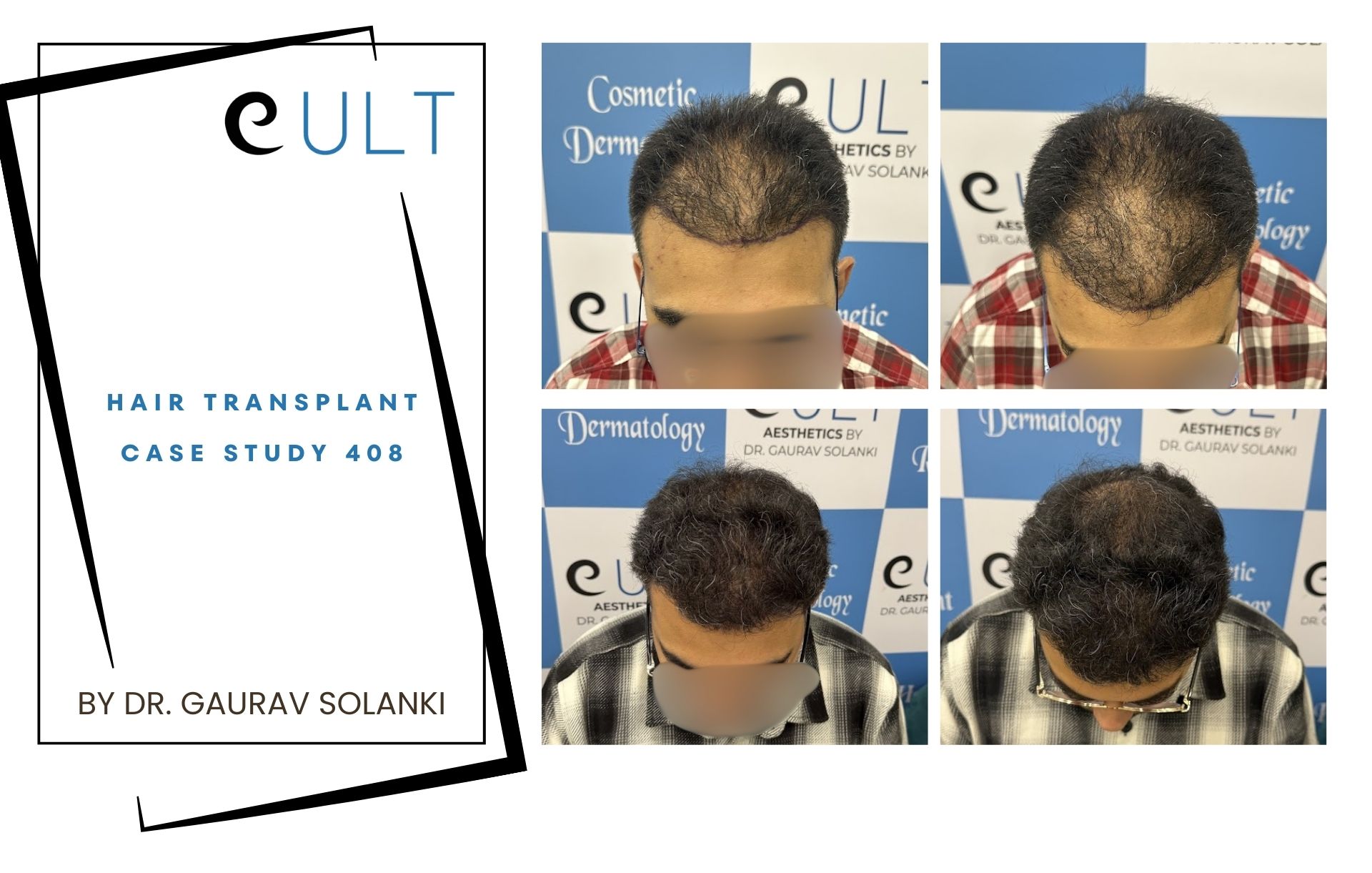 Hair Transplant case 408