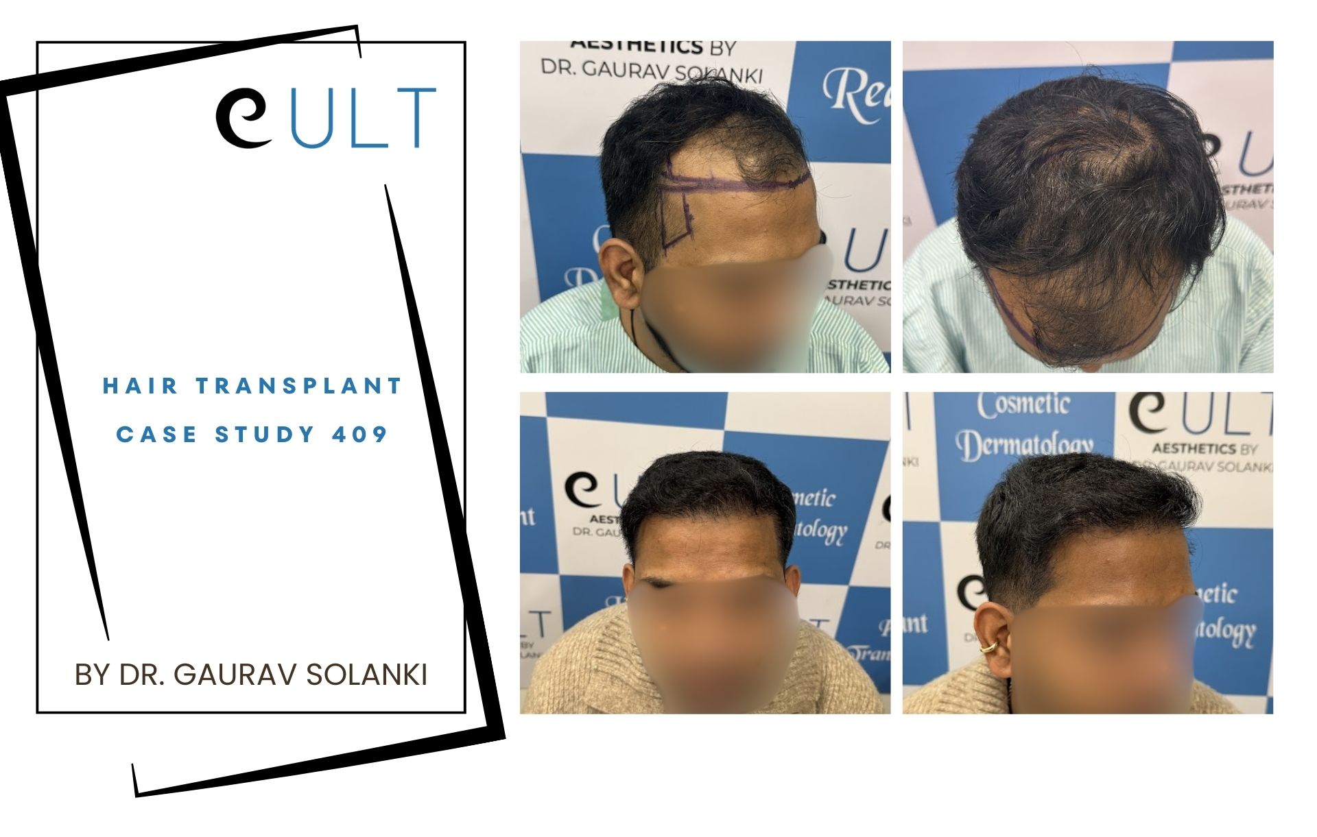 Hair Transplant case 409