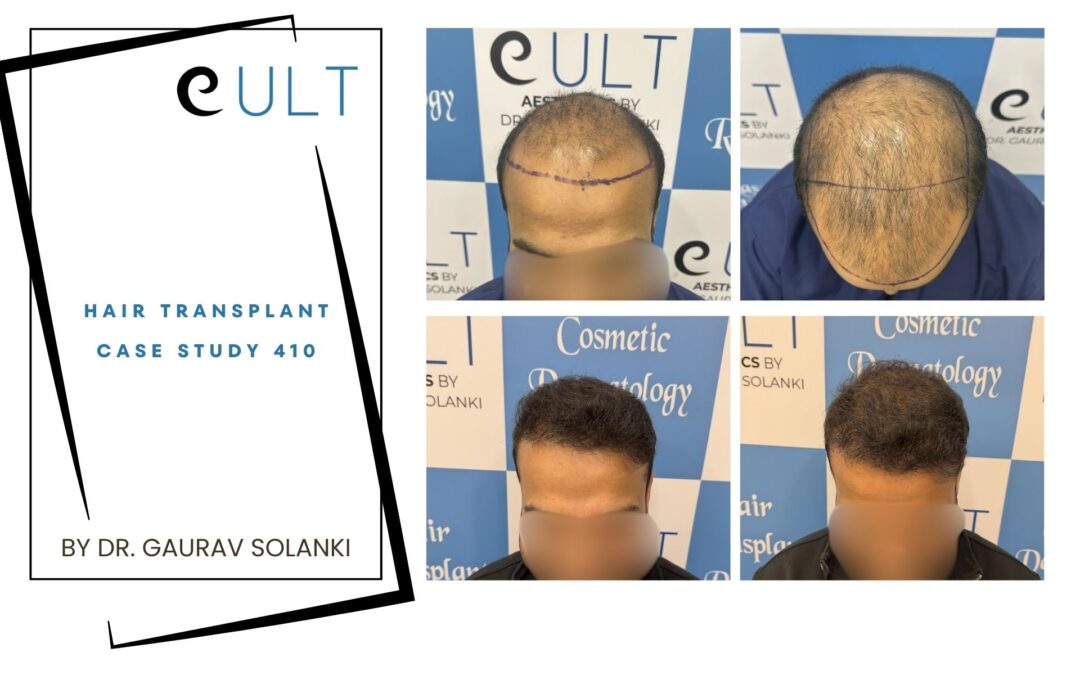 Hair Transplant Case 410