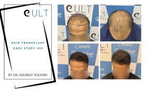 Hair Transplant case 410