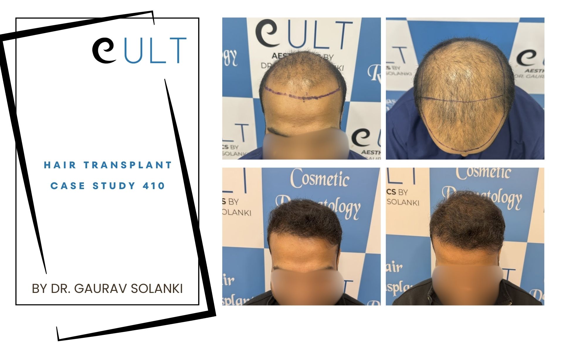 Hair Transplant case 410