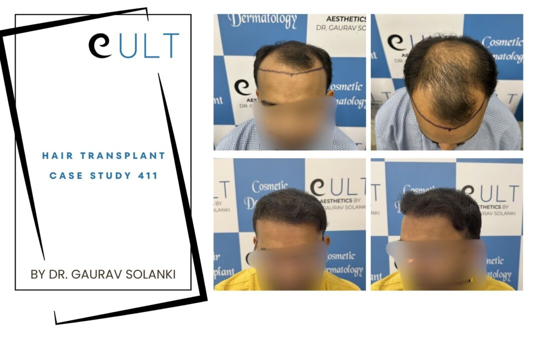 Hair Transplant Case 411