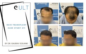 Hair Transplant case 411