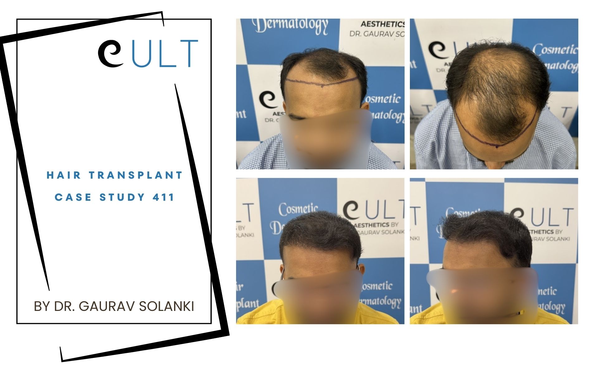 Hair Transplant case 411