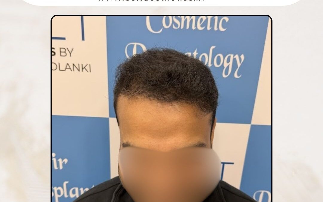 Hair Case 410 After 1