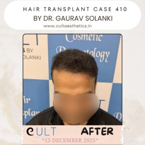 hair case 410 After-1