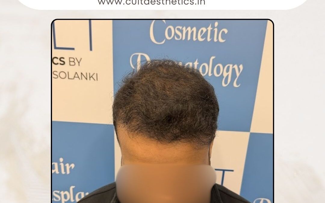 Hair Case 410 After 2