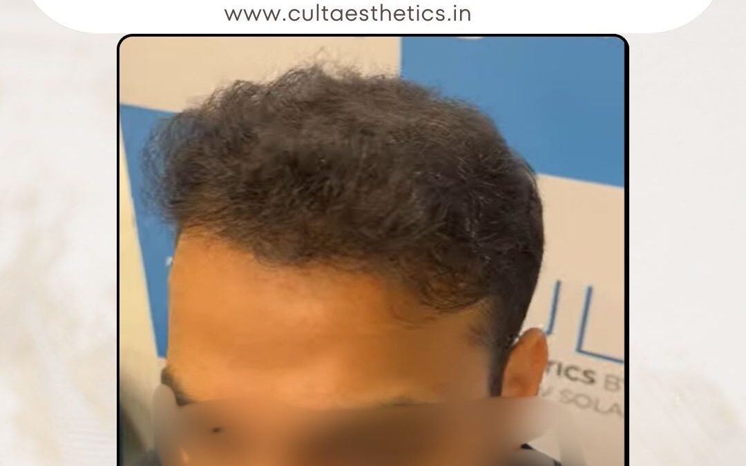 Hair Case 410 After 4