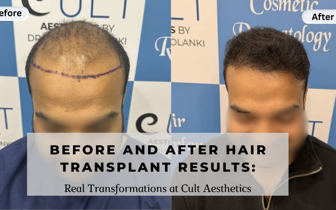 Before and After Hair Transplant Results: Real Transformations at Cult Aesthetics