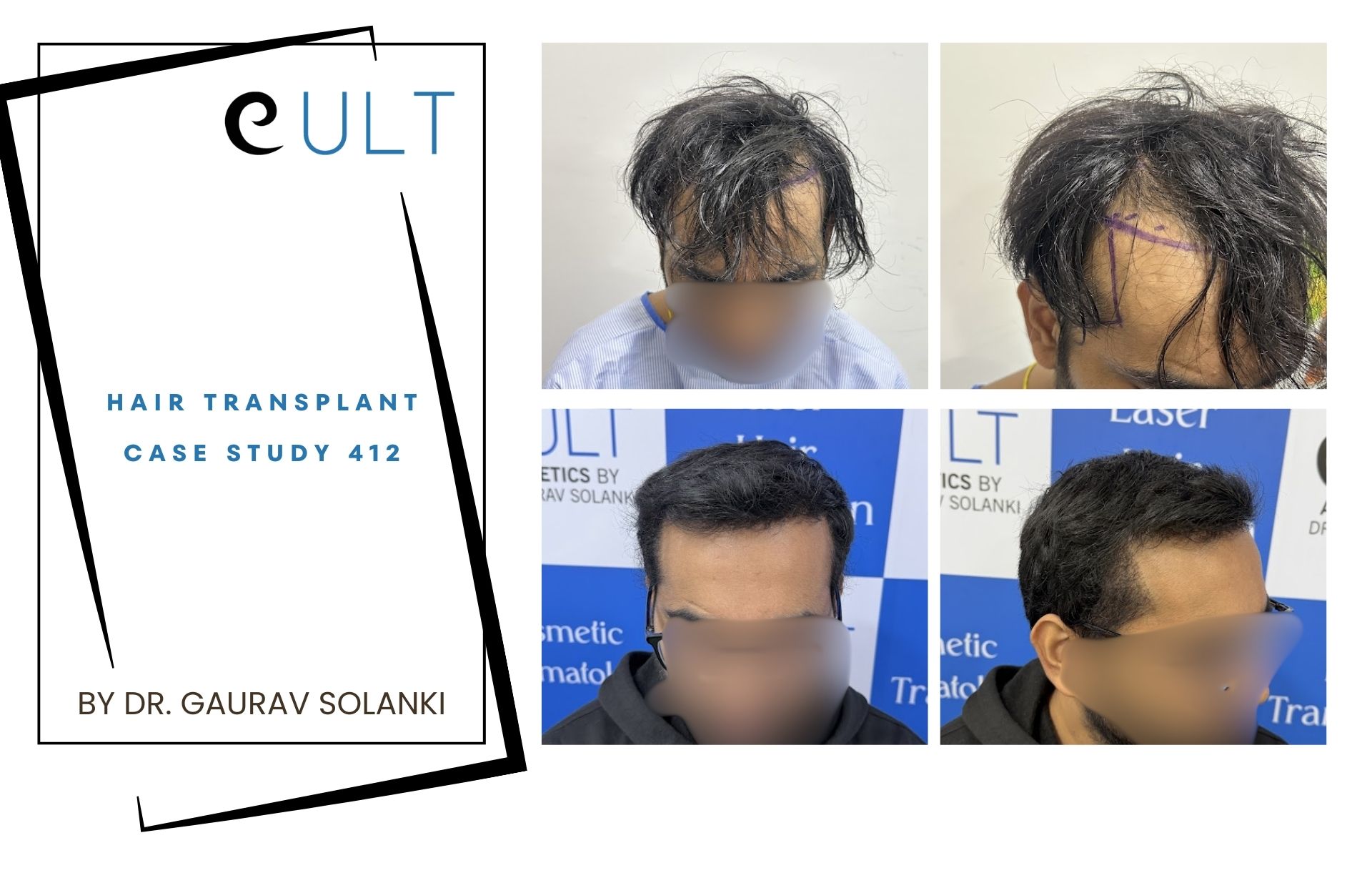 Hair Transplant case 412