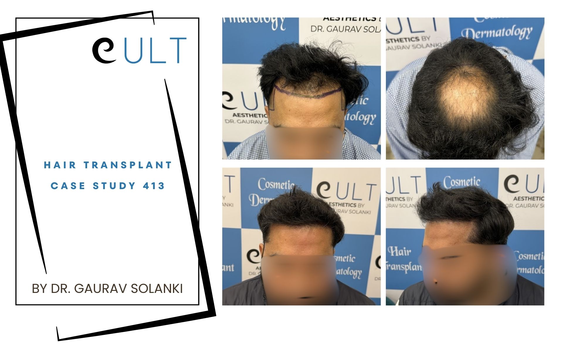 Hair Transplant case 413