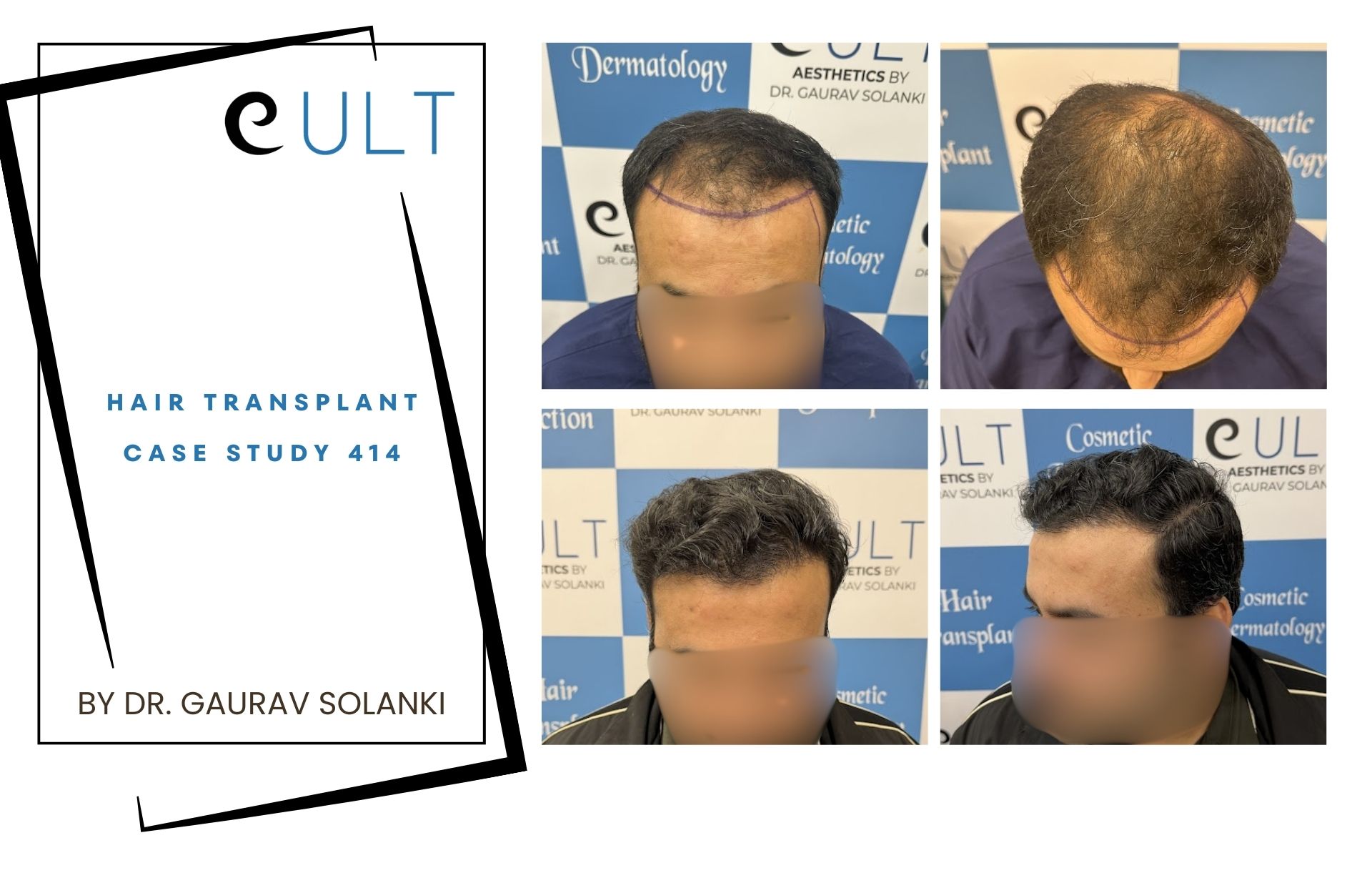 Hair Transplant case 414
