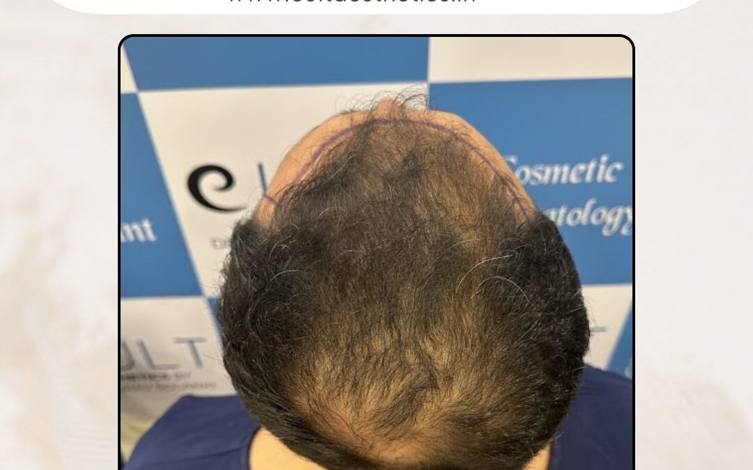 Hair Case 414 Before 3
