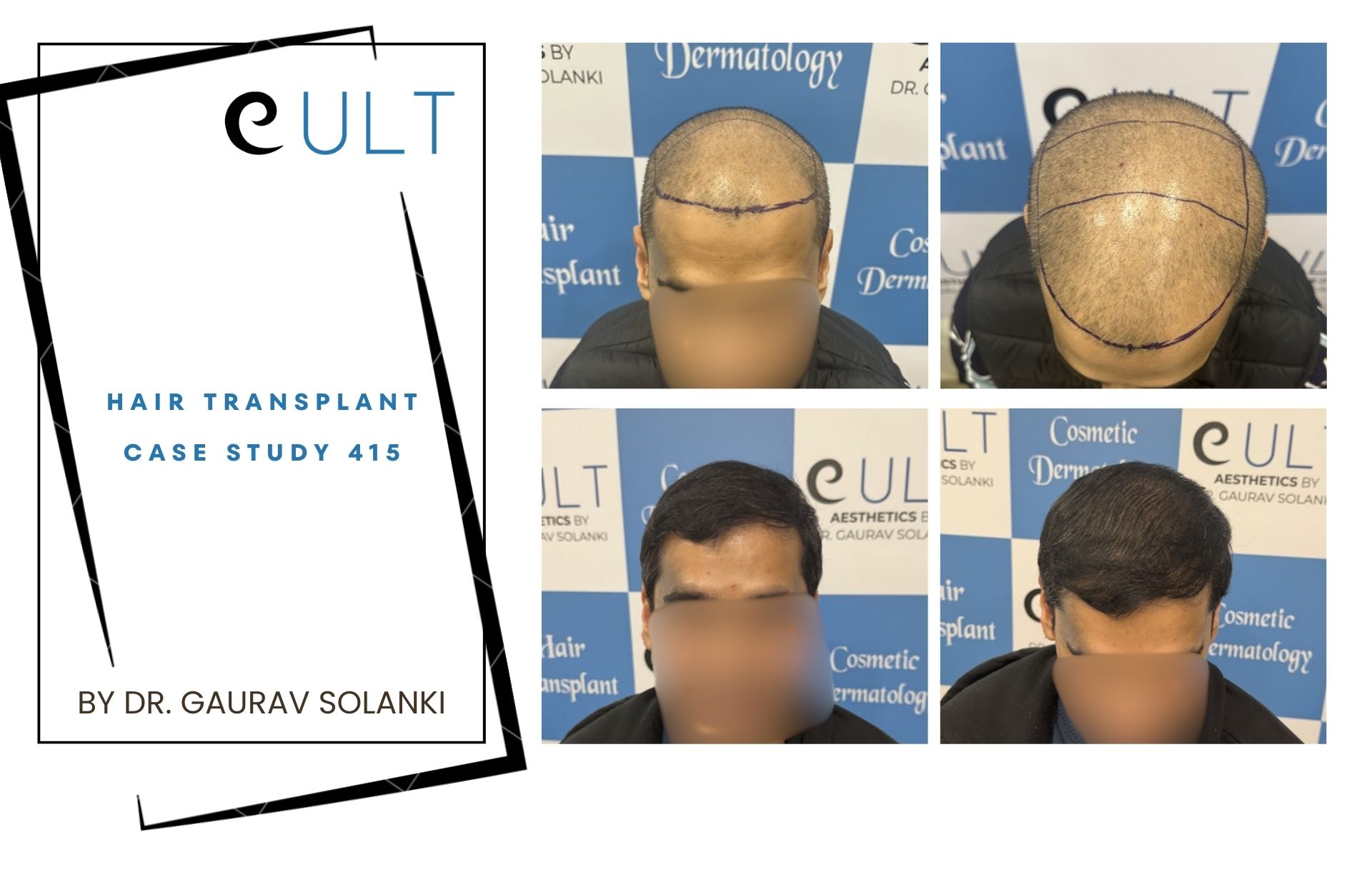 Hair Transplant case 415
