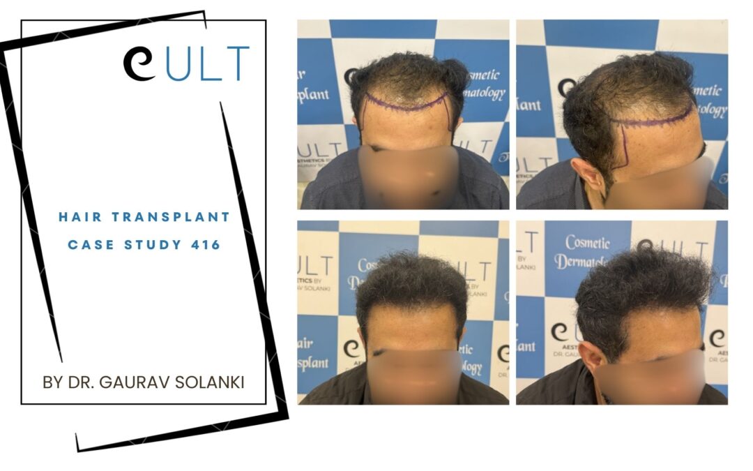 Hair Transplant Case 416