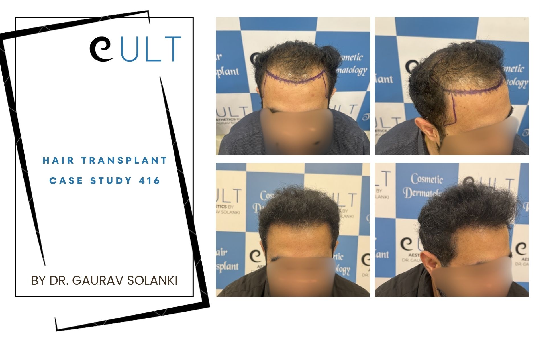 Hair Transplant case 416