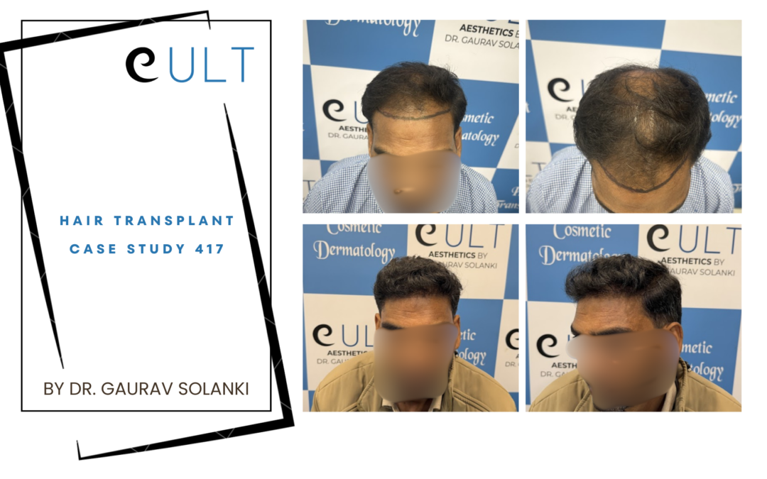 Hair Transplant Case 417