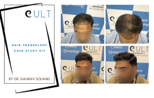 Hair Transplant case 417