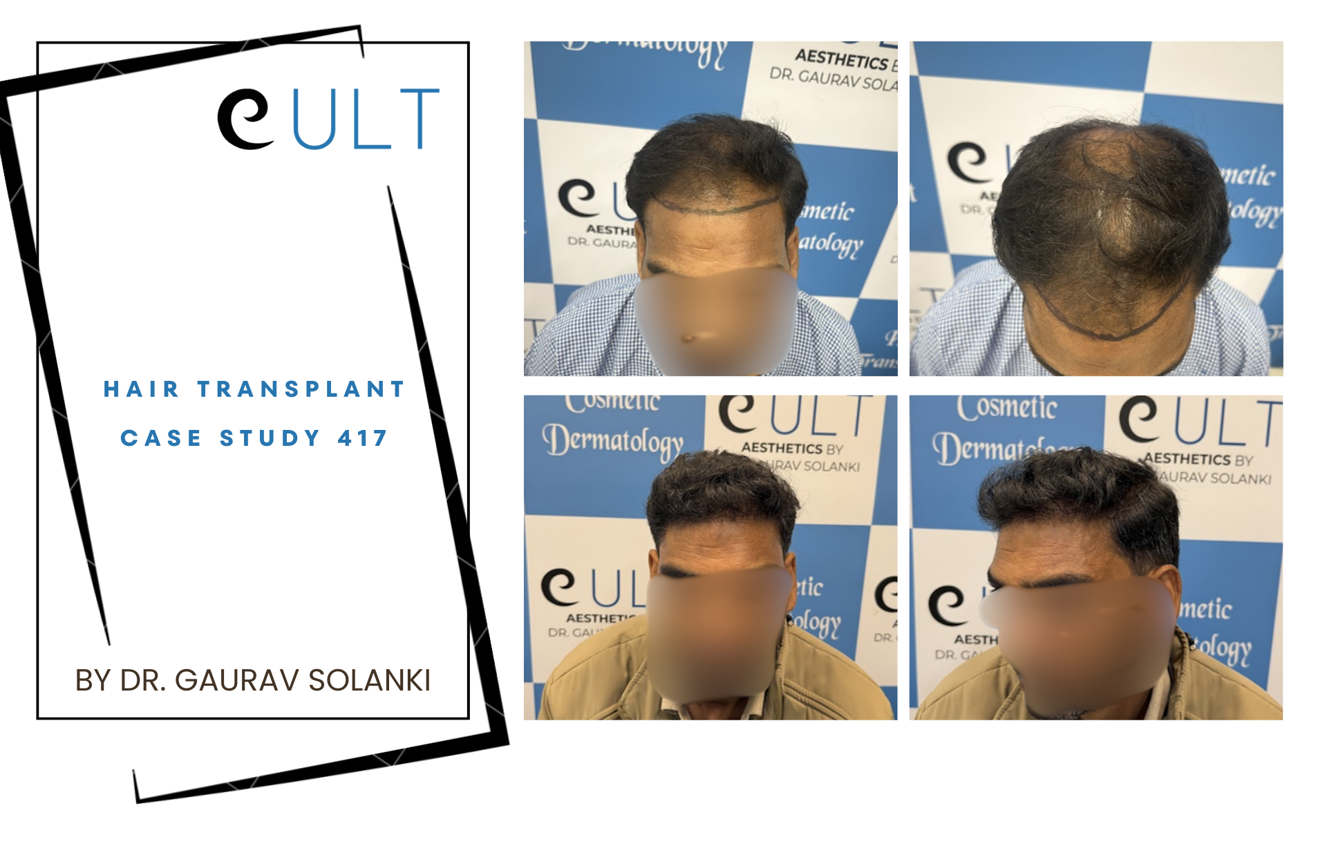 Hair Transplant case 417