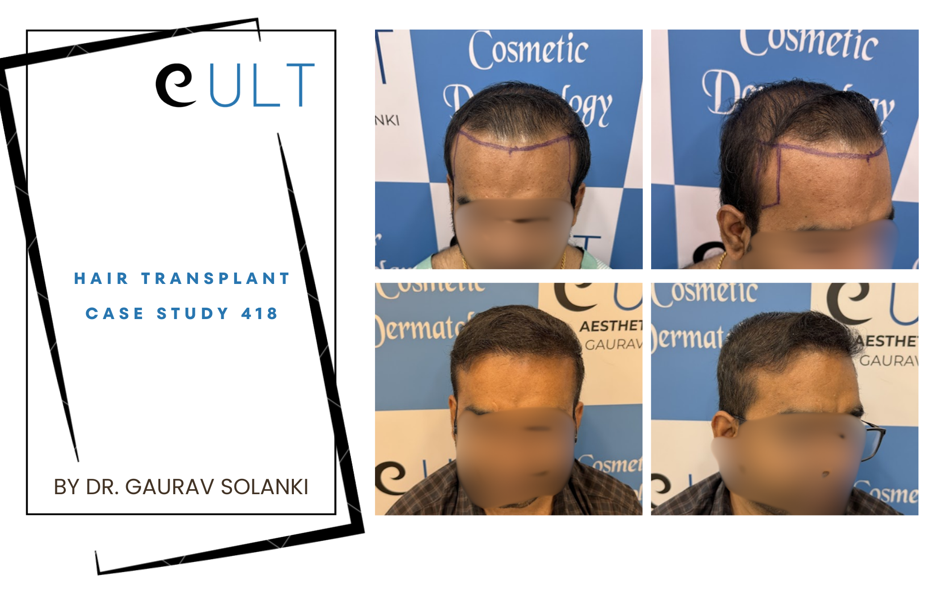 Hair Transplant case 418