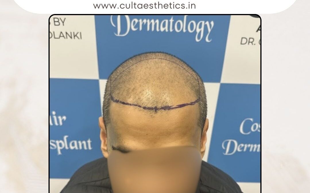 Hair Case 415 Before 1