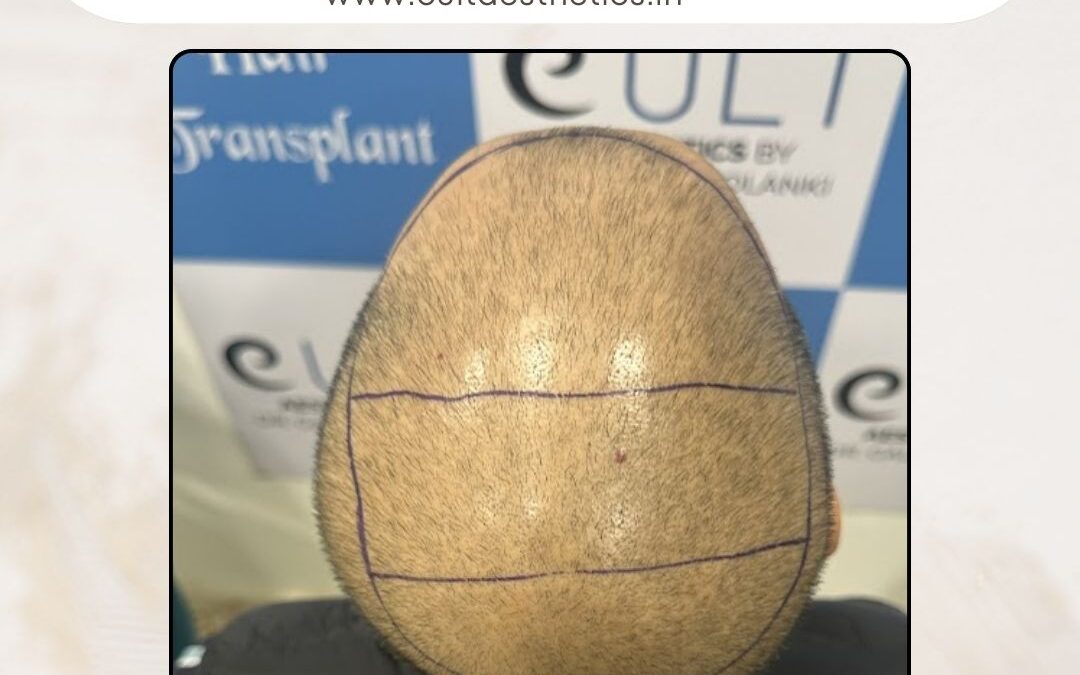 Hair Case 415 Before 2