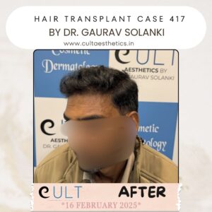 hair case 417 After-3